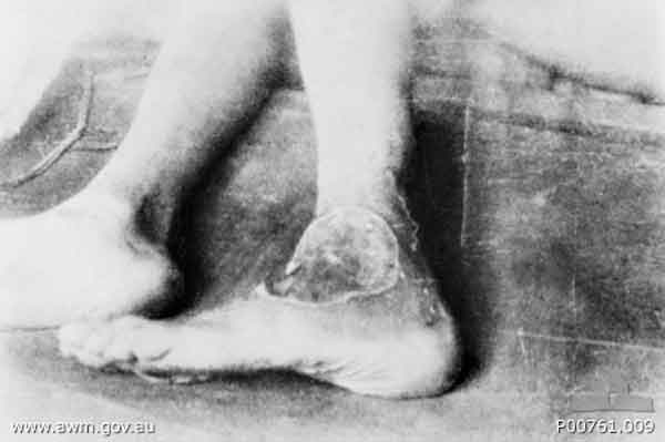 Tropical ulcer
Tarsau (Tarsoe), Thailand. 1943. Close up of a tropical ulcer on the ankle of a prisoner of war (POW). Tarsau, now known as Nam Tok, is 130 kilometres north of Nong Pladuk (also known as Non Pladuk), or 284 kilometres south of Thanbyuzayat. It was used by the Japanese as both a staging camp for POWs moving north to work on railway construction, and a base hospital during the period November 1942 to April 1944. During this period 15,029 sick passed through it, of whom 806 died. (Donor A. Mackinnon)
